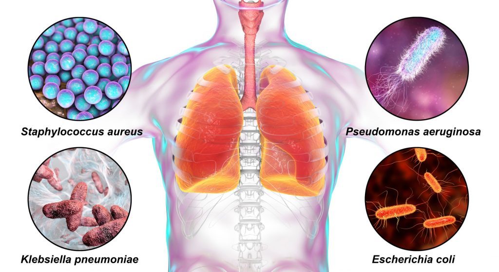 Indemnisation suite à une infection nosocomiale