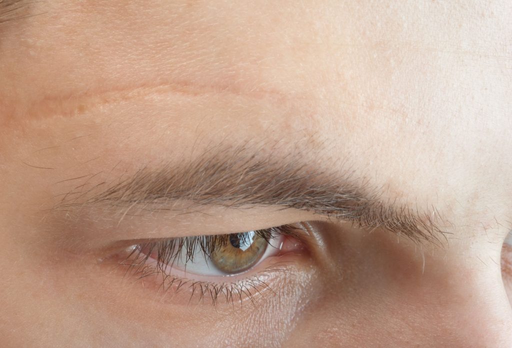 Préjudice esthétique permanent